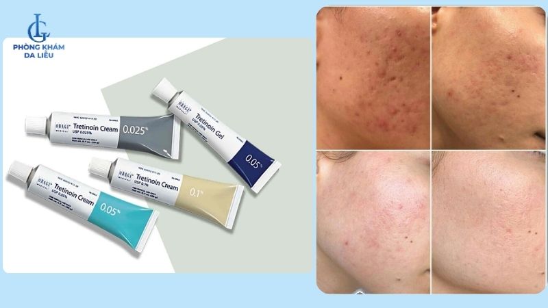 nồng độ tretinoin