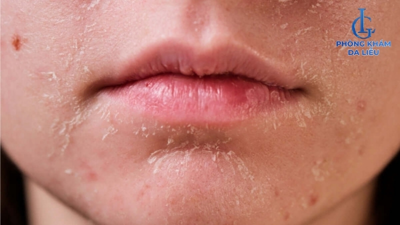 tretinoin trị sẹo