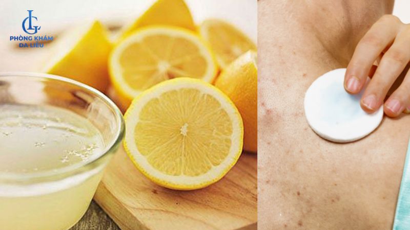 Chanh tươi điều trị mụn lưng