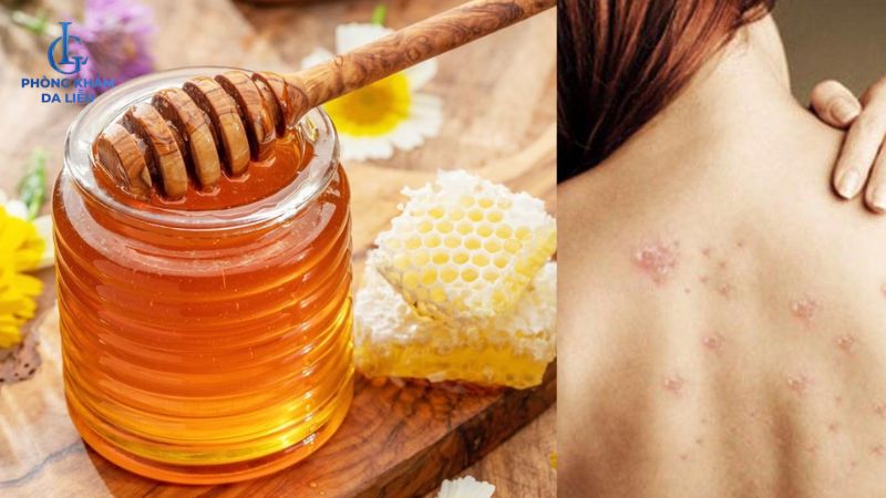 Cách trị mụn lưng bằng mật ong