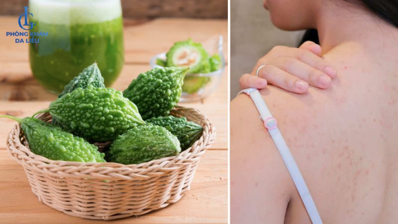 Khổ qua trị mụn lưng