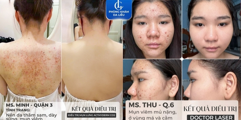 trị mụn ở tphcm