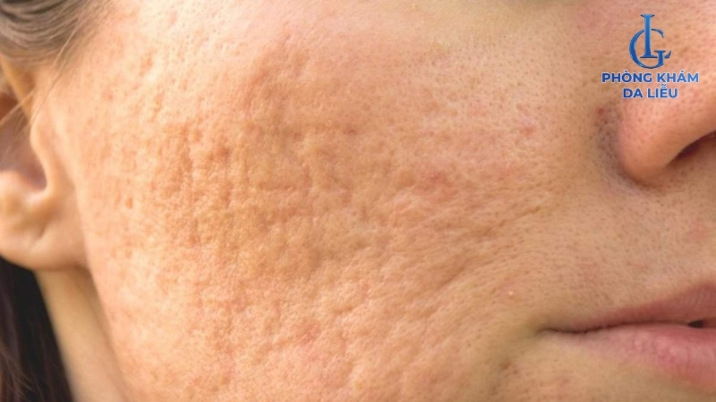 trị sẹo lõm lâu năm tại nhà