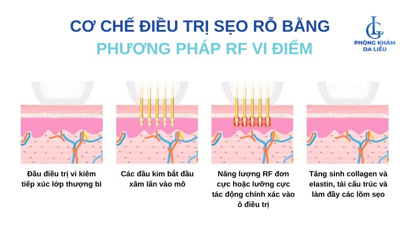 trị sẹo rỗ bằng RF vi điểm