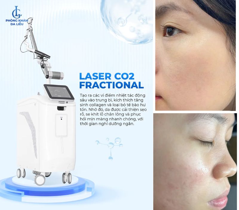 trị sẹo rỗ bằng Laser