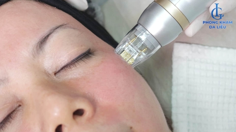 trị sẹo rỗ có đau không