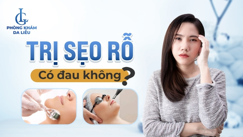 trị sẹo rỗ có đau không