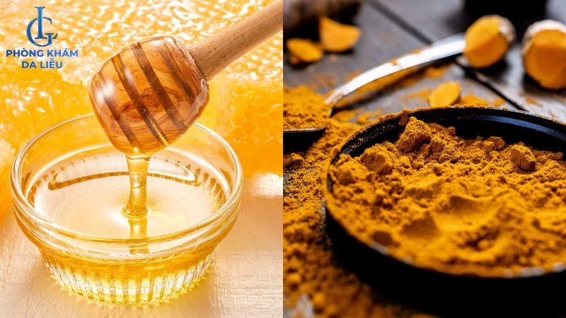 trị sẹo rỗ tại nhà bằng nghệ tươi và mật ong