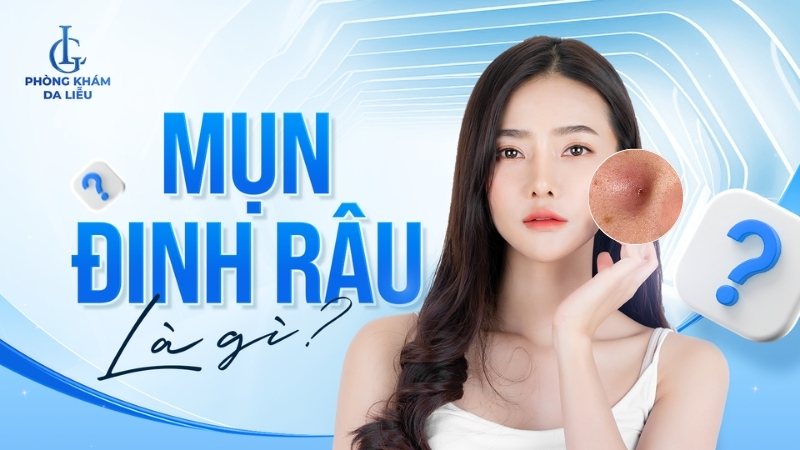 Mụn đinh râu là gì