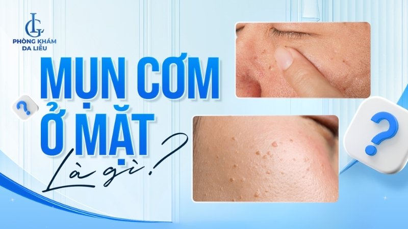 Mụn cơm ở mặt