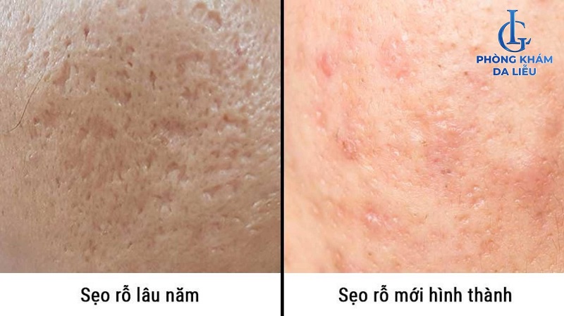 Phân biệt sẹo lõm mới hình thành và sẹo lõm lâu năm