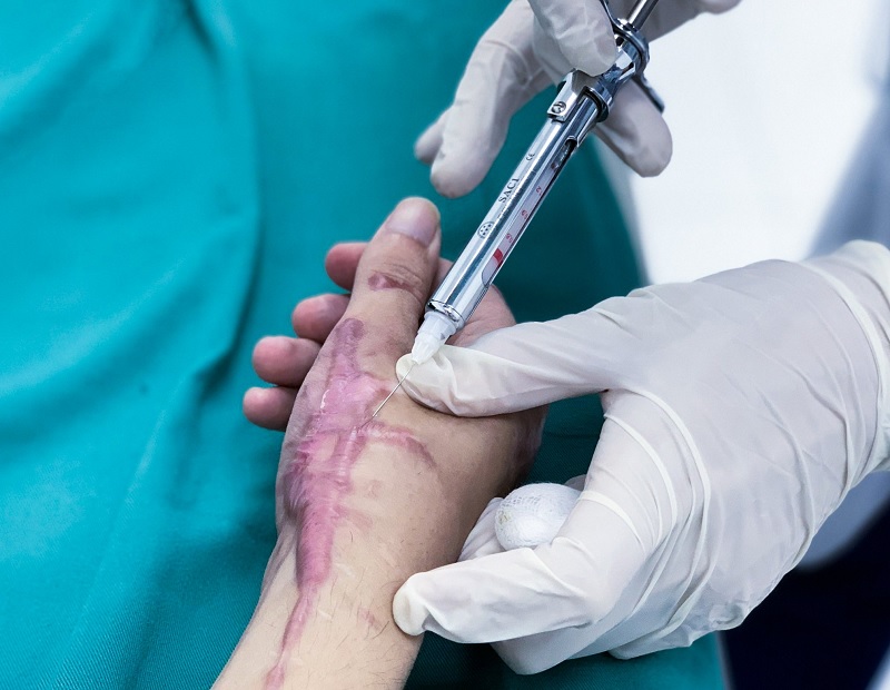 cách trị sẹo lồi lâu năm