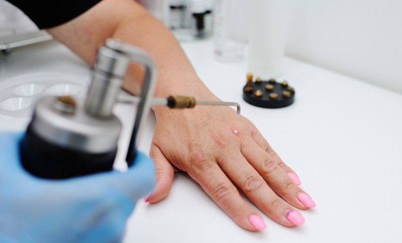 Áp lạnh điều trị sẹo lồi lâu năm