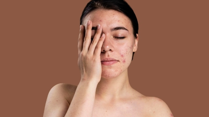 Mụn dị ứng mỹ phẩm có tự hết không?