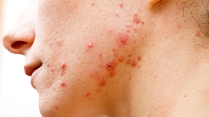 bị dị ứng mỹ phẩm nổi mụn