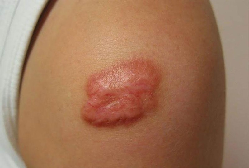 Tại sao sẹo lồi lại đau?