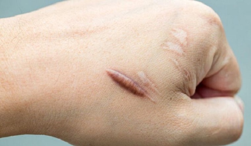 Tại sao sẹo lồi gây ngứa?