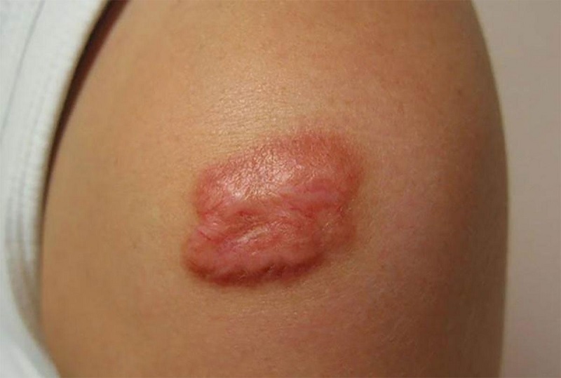 Sẹo lồi có tự hết không?