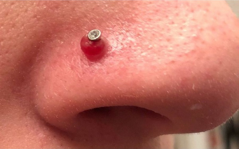 Sẹo lồi ở mũi là gì?