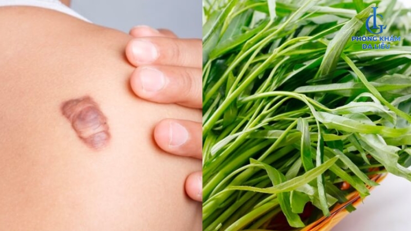 Ăn rau muống có bị sẹo lồi không?