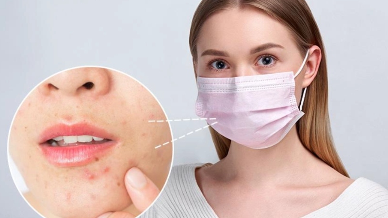 Có nên đeo khẩu trang khi bị mụn?