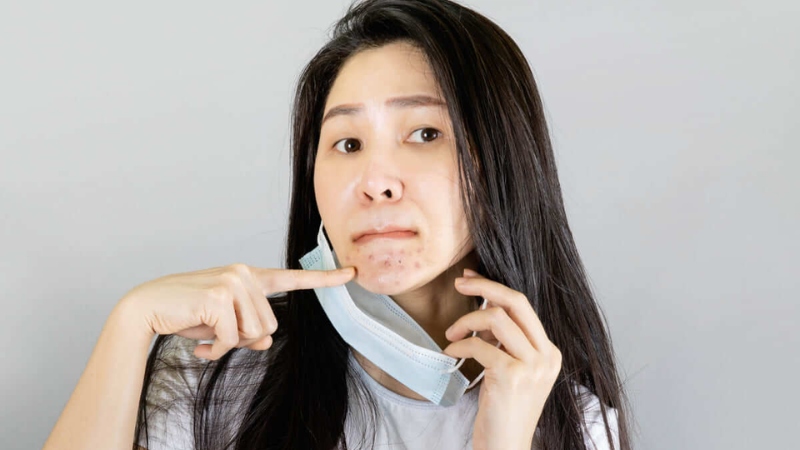 Đeo khẩu trang nhiều có bị mụn không?