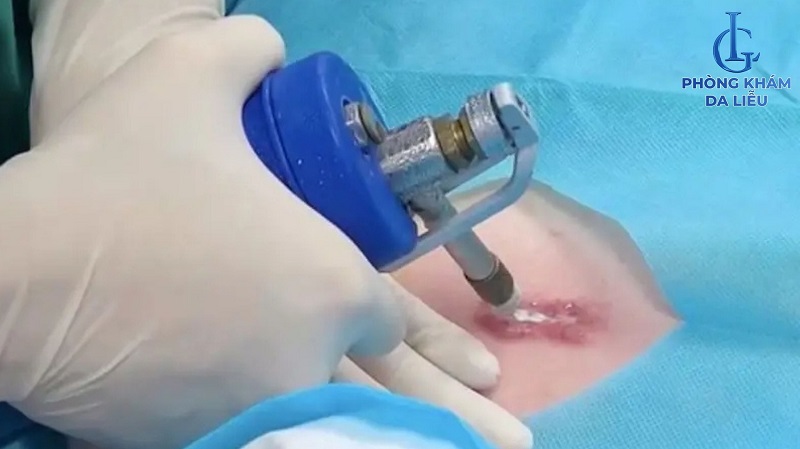 chấm nito lỏng sẹo lồi