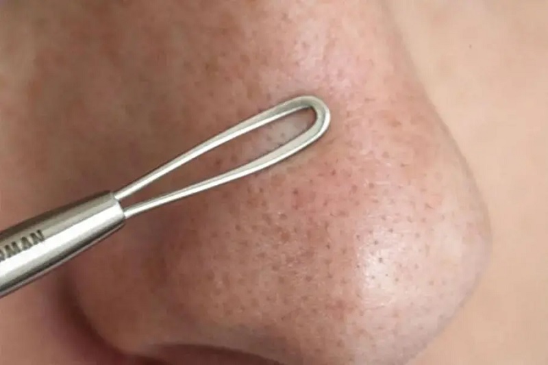 nặn mụn đầu đen ở mũi