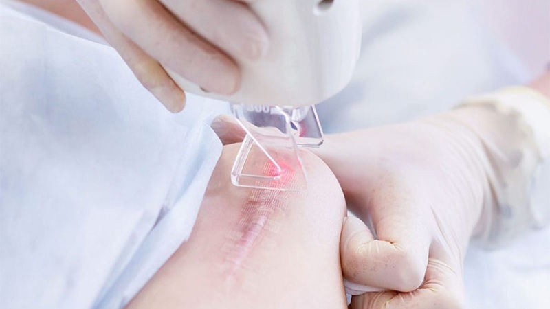 Laser Fractional CO2 trị sẹo lồi