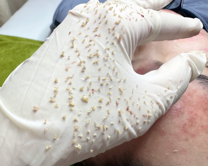 Lấy nhân mụn có tốt không?