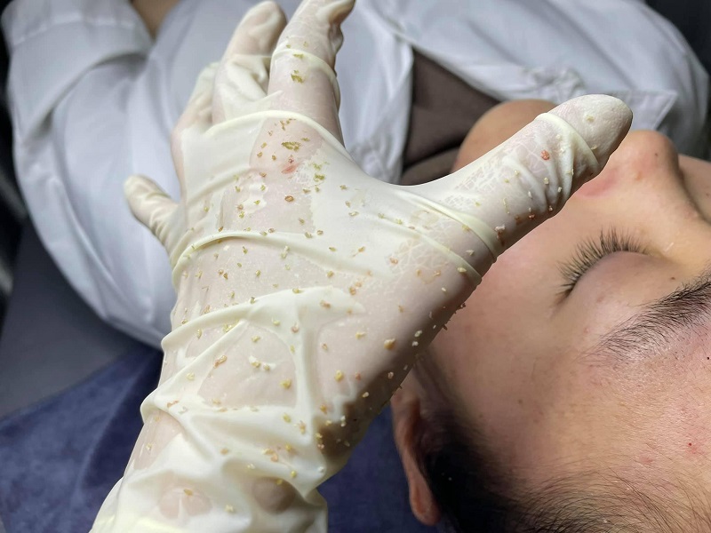 Lấy nhân mụn có hết mụn hoàn toàn không?