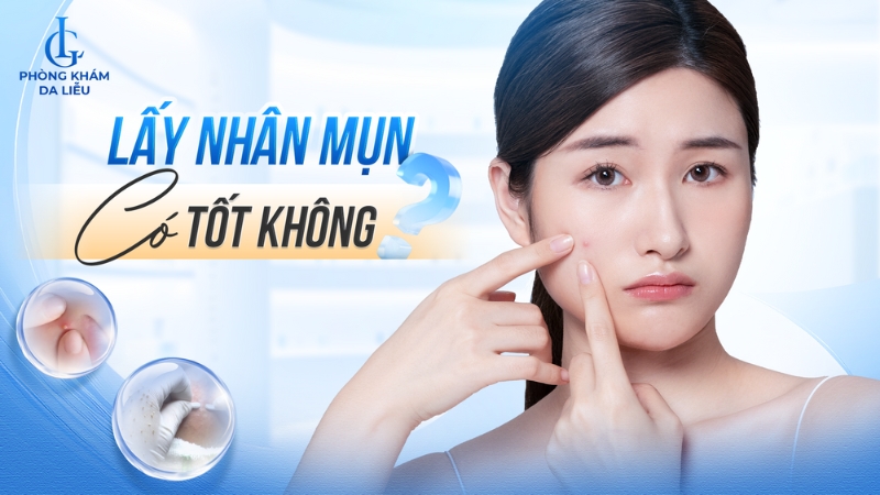 Lấy nhân mụn có tốt không?