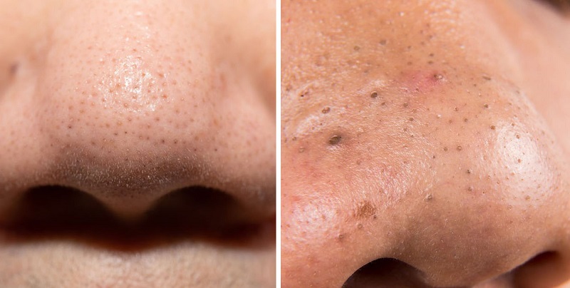 Phân biệt sợi bã nhờn và mụn đầu đen