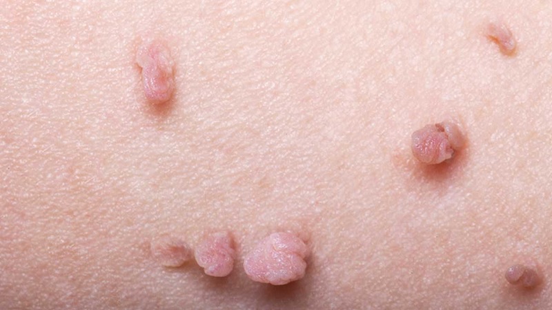 Mụn thịt là gì?
