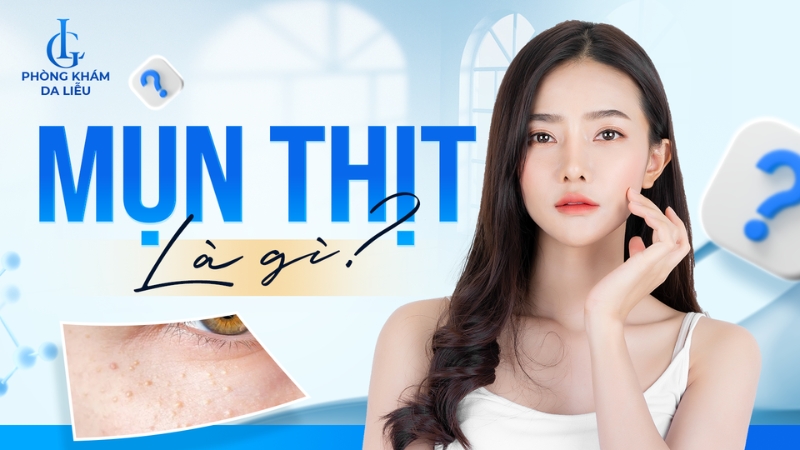 Mụn thịt là gì?