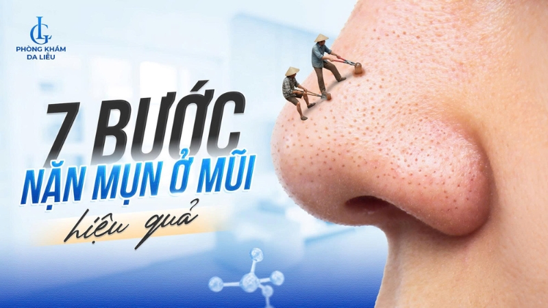 7 bước nặn mụn đầu đen ở mũi