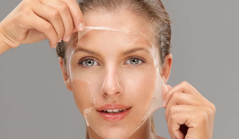 Ưu và nhược điểm của peel da trị mụn