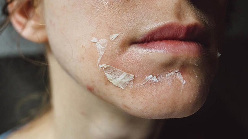 Peel da trị mụn là gì?