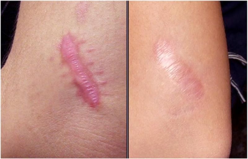 hình ảnh trước và sau khi điều trị sẹo lồi
