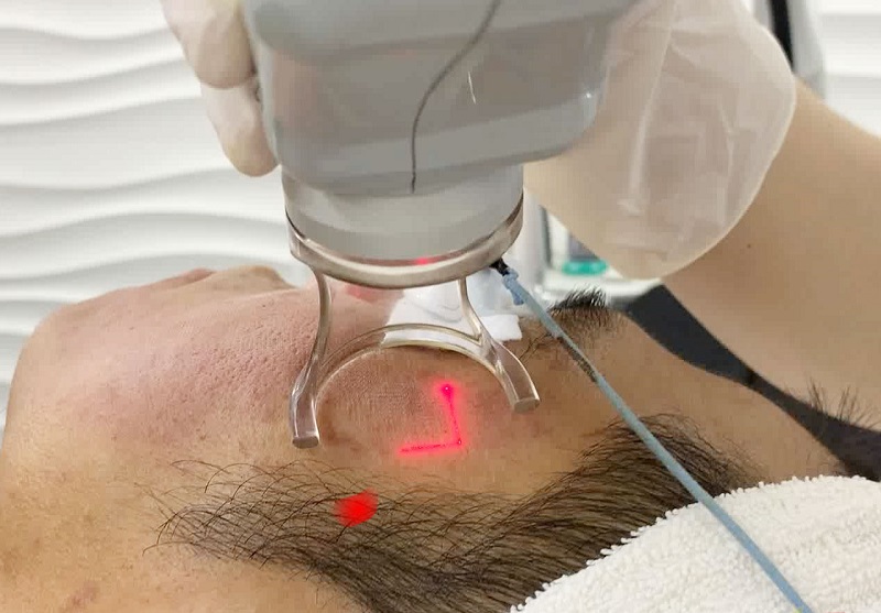 trị sẹo lồi bằng công nghệ laser co2 fractional