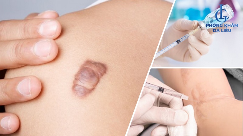 Tiêm corticosteroid​ trị sẹo lồi lâu năm
