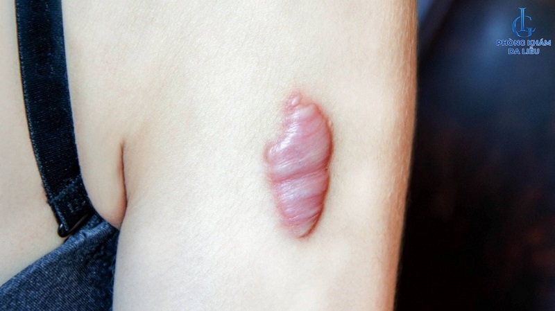 cách trị sẹo lồi lâu năm