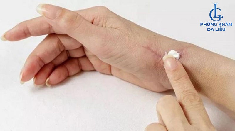 kem trị sẹo lồi