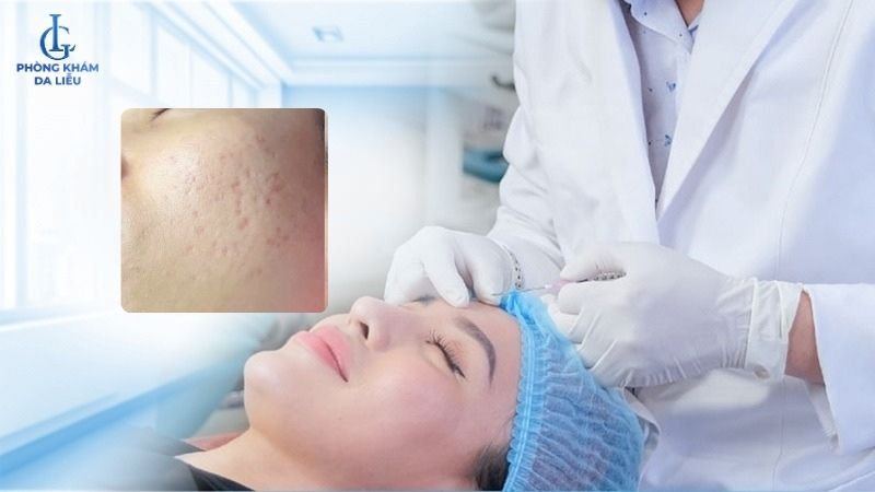 bóc tách đáy sẹo rỗ