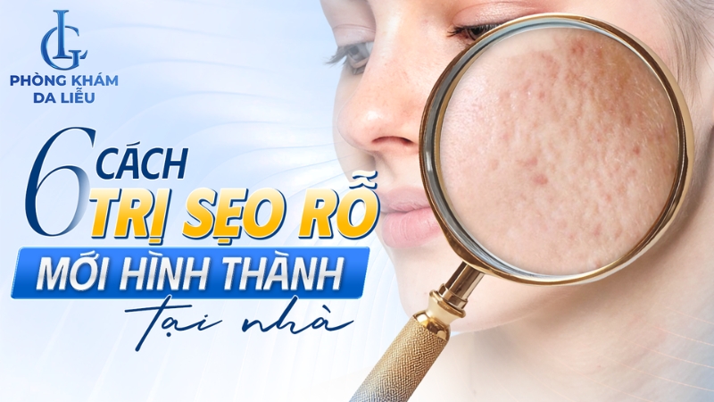 Cách trị sẹo rỗ tại nhà