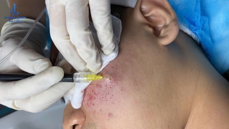 Cắt đáy sẹo bằng khí CO2