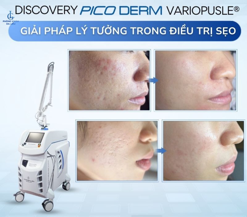 Laser Discovery trị sẹo rỗ nhẹ