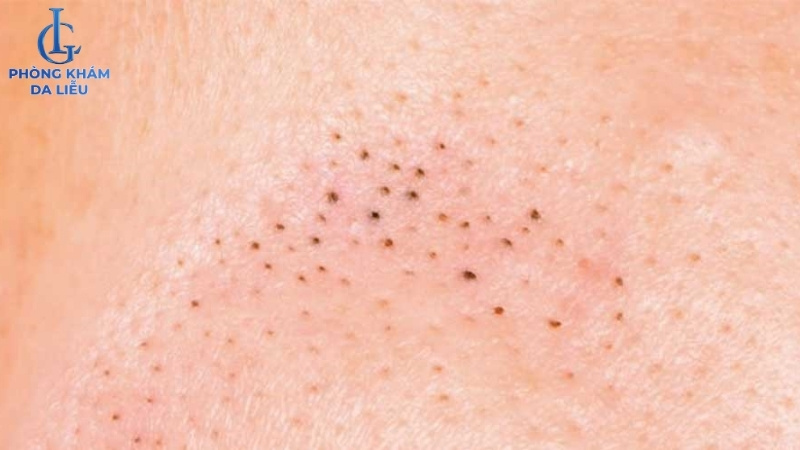 Mụn đầu đen ở lưng