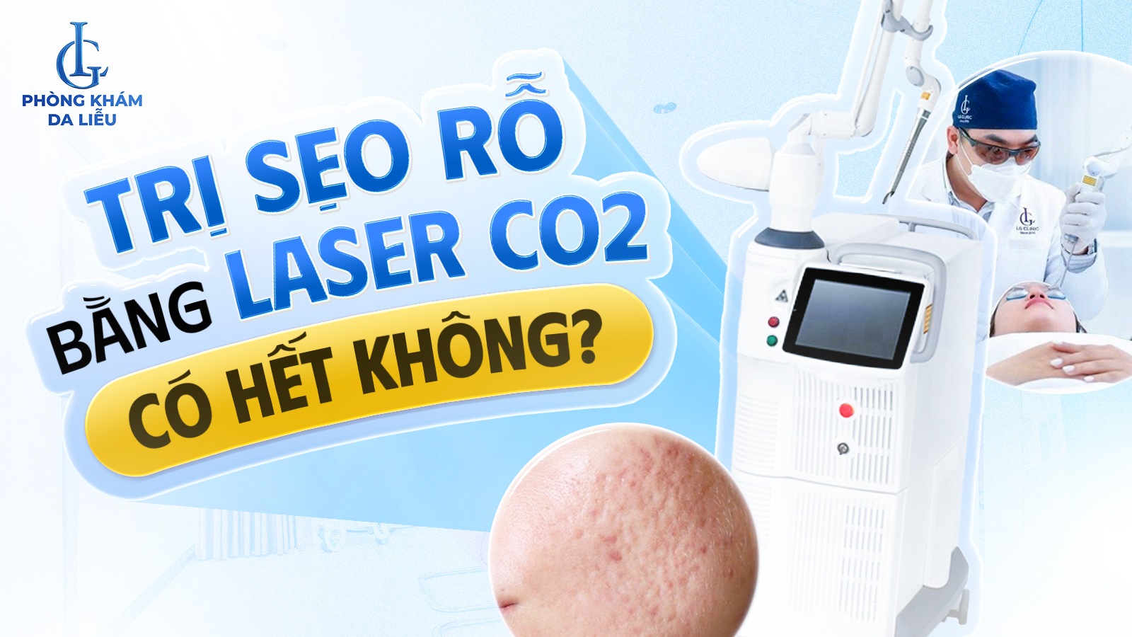 Trị sẹo rỗ bằng laser CO2 có hết không