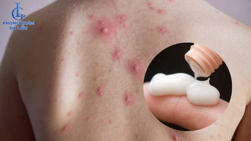 bôi thuốc trị mụn lưng và ngực